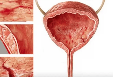 Le ragioni dello sviluppo della cistite nelle donne